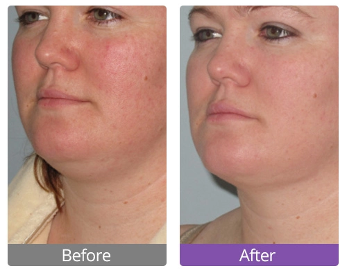 face cavitation before and after